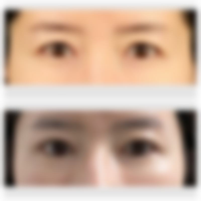 眼部松弛不理想，切开手术打造持久成效