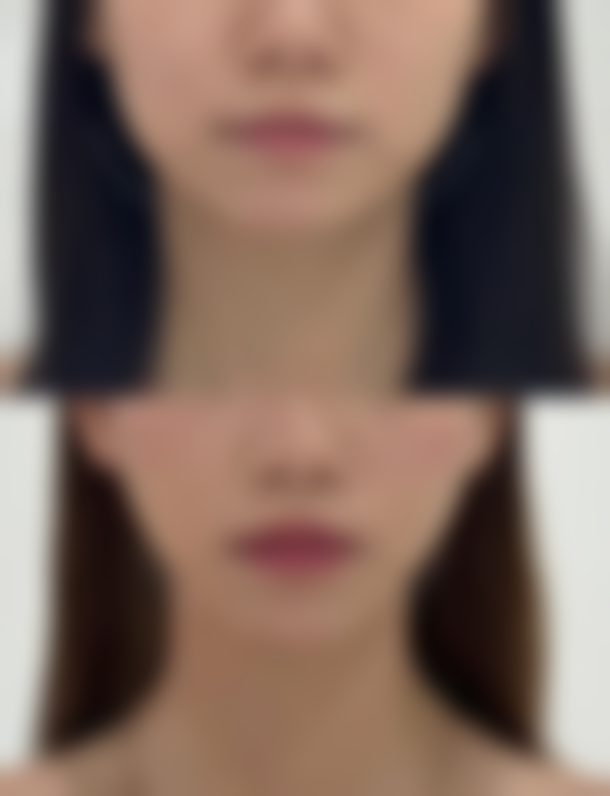 切缝疤痕手术修复时间与年龄有关吗？