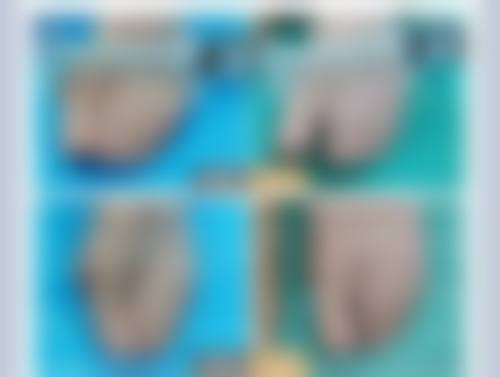 [XX 整形医院]：专精解决眼皮松弛难题