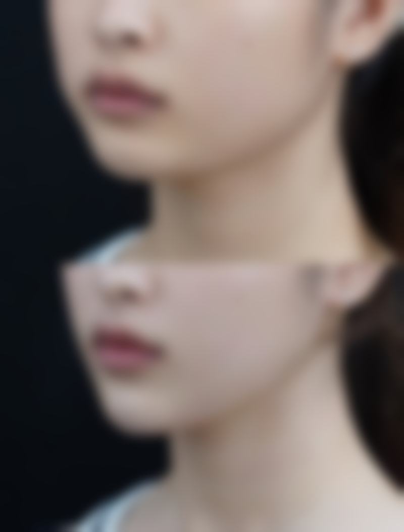 重庆肖林做正颌手术价格多少？含地包天4万起、凸嘴4万起，坐诊松山医院 