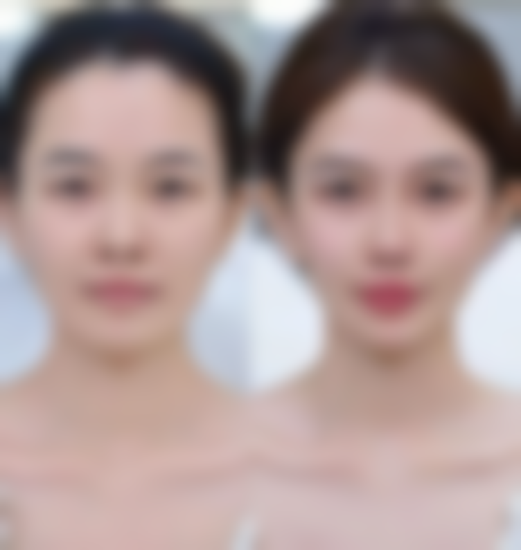 [XX 整形医院]割双眼皮改善眼皮松弛的收费详情