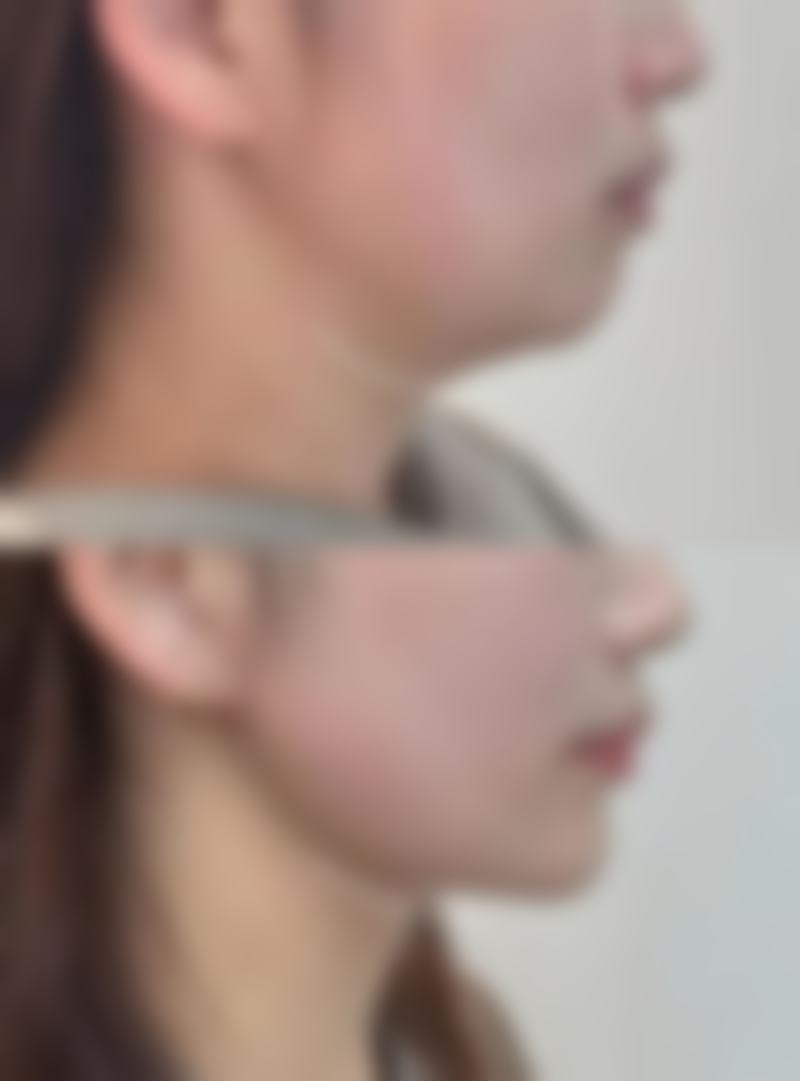 手术成效：自然持久，满意度高