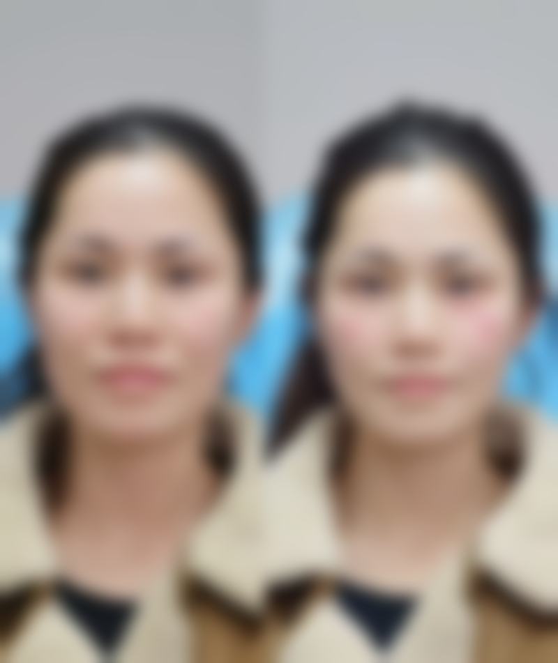 减少创伤：内窥镜隆胸快速修复与良好成效的秘诀