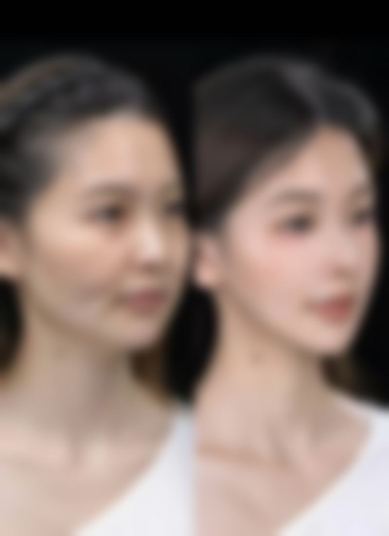 北京美莱瘦脸针实例成效展示