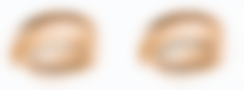 双眼皮宽变窄修复难度大吗？大！但上海九院和北京八大处有招，费用1.5 - 5万！ 