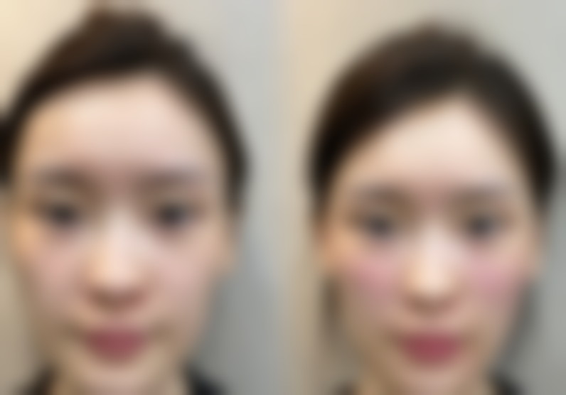 北京八大处：双眼皮宽变窄修复的具有影响力之选