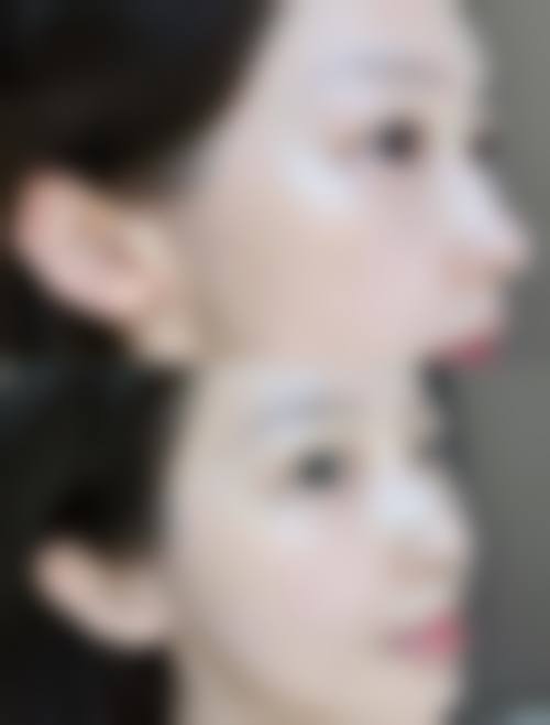 烟台韩东均整形诊所真实实例参考