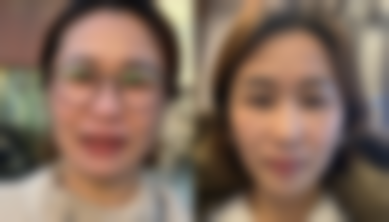 全切双眼皮：两周左右谨慎尝试淡妆