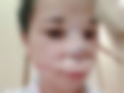 疤痕色素沉着用什么好？药物、激光治疗都行，西京医院还能用调Q激光淡化色素！ 