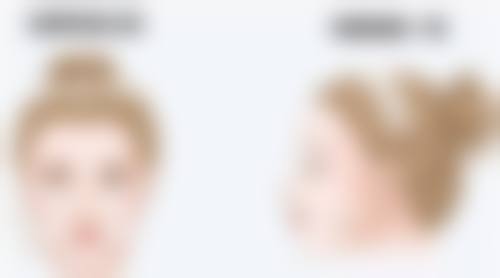 熬夜致水肿加重，眼睛肿成“核桃”