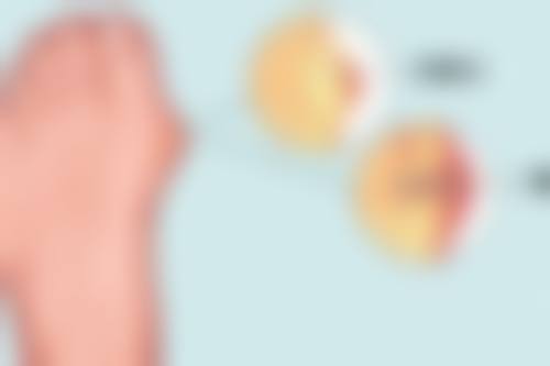 光子嫩肤治疗疤痕的注意事项