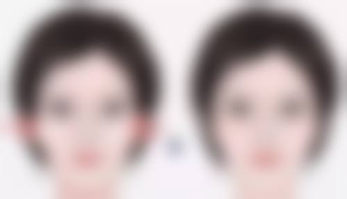 替代光子嫩肤治疗疤痕的方法