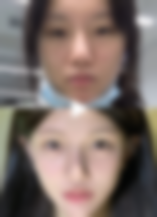 不同人群打瘦脸针的成效差异