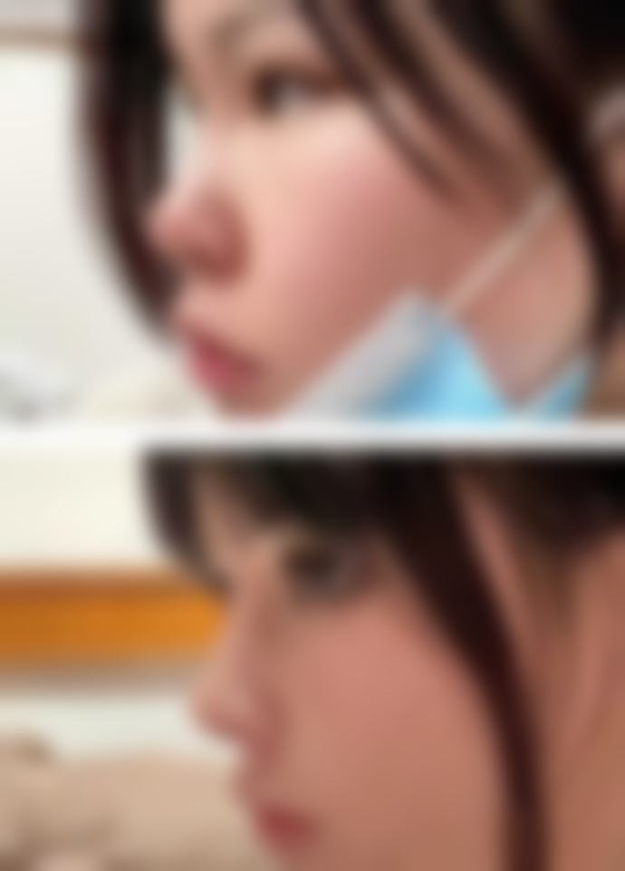 瘦脸针是不是越打越大？正规操作+良好习惯不会！过度注射或常嚼硬物才可能反弹