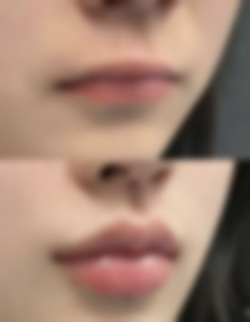 生活习惯对瘦脸成效的影响