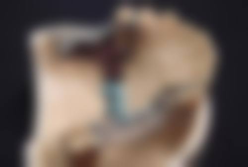 手术切除：完全解决黑色疤痕