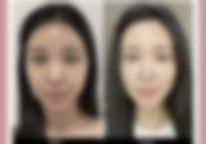 药物治疗：对抗黑色疤痕的利器