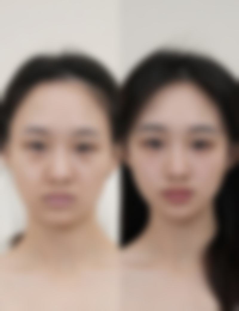 割双眼皮第二天可以正常上班吗？埋线且肿胀不严重可考虑，全切则建议休息（影响恢复且肿胀明显） 