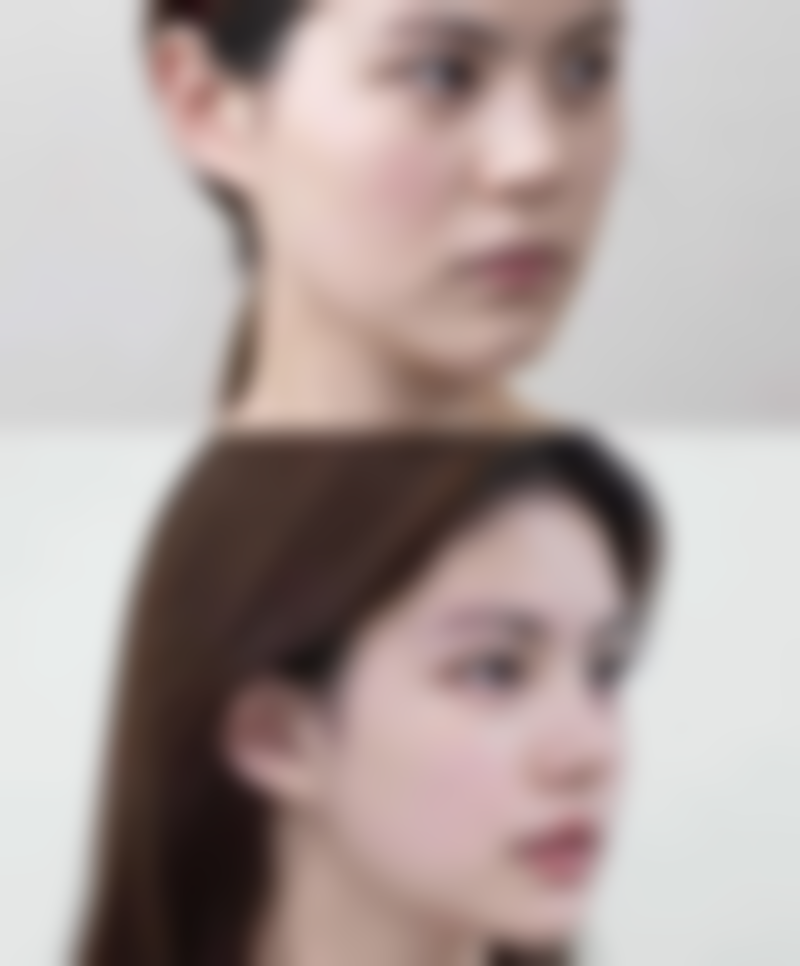 激光治疗：效率高去除黑色疤痕