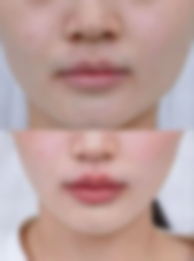 十、许昌正美韶华医疗整形小腿吸脂塑形后续服务