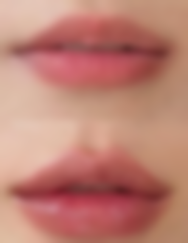 剖腹产疤痕带来的“新病”困扰