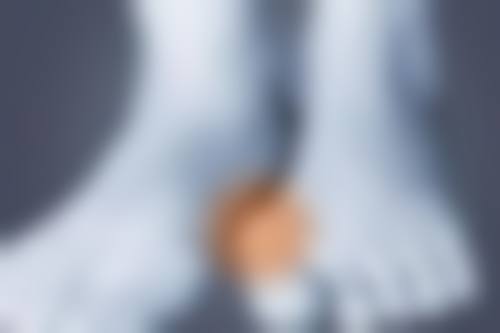 眼袋有淤青怎么快速消除？初期冰敷、后期热敷，再配合饮食和药物，轻松搞定！ 