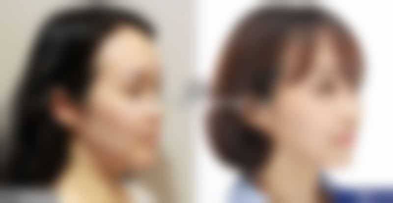 纳米无痕双眼皮的线是什么颜色？通常是白色或透明色医用缝合线，数月可自然分解！ 