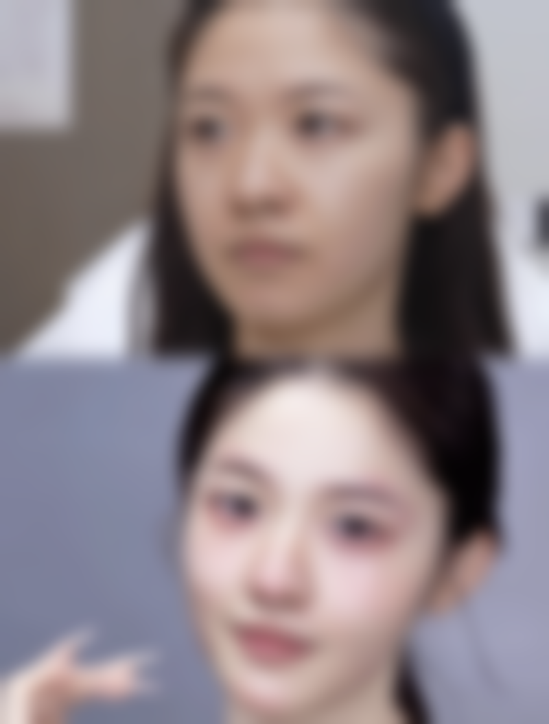 其他治疗:针对顽固淤青的特殊手段