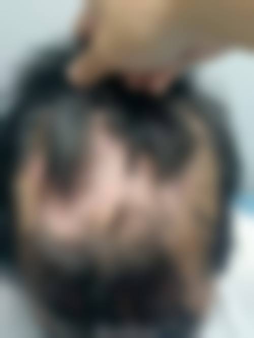 广西最好植发医院排名：揭秘口碑佳、技术优的植发医院，含预约电话 xxx