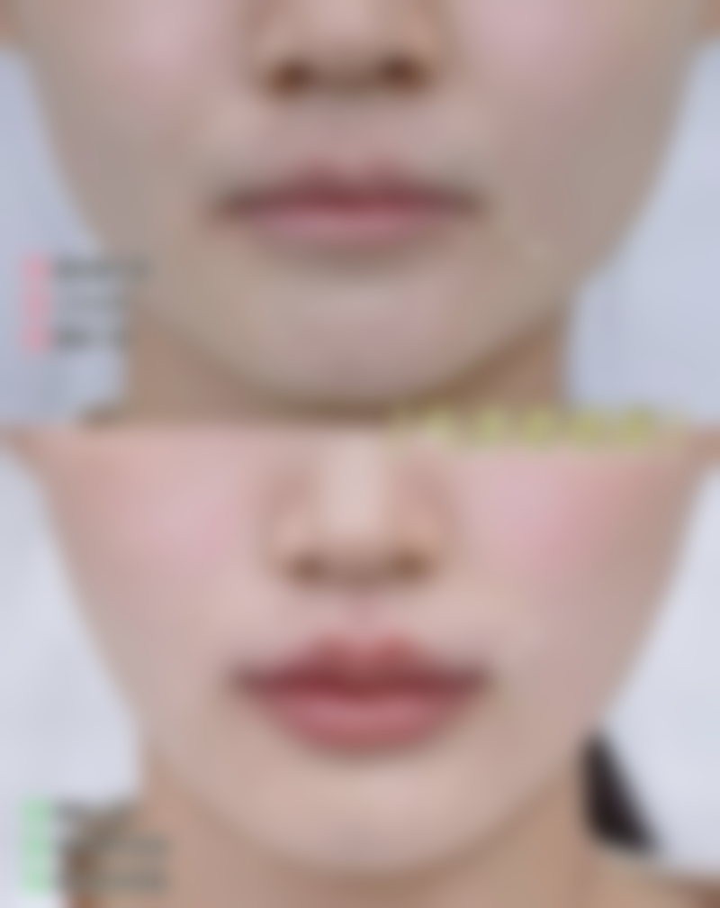 日常护理：辅助三眼皮变回双眼皮