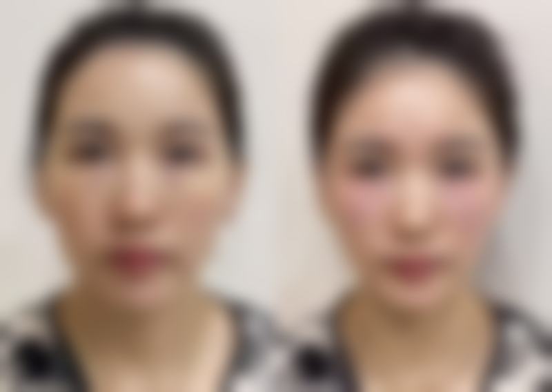 眼部按摩：促进血循环助修复