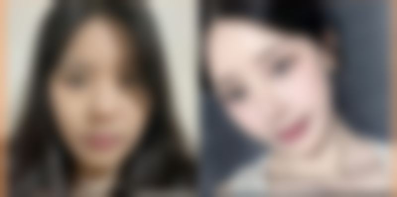 外切双眼皮多久能恢复完全自然？一般1 - 6个月，恢复时间受个体、术式和护理等因素影响！ 