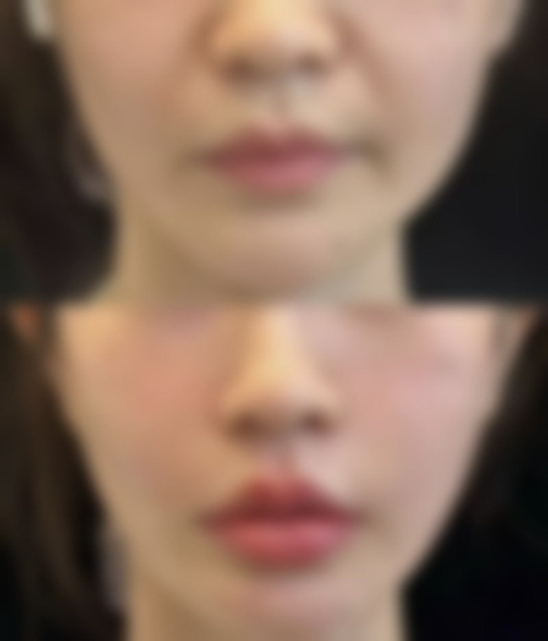 双眼皮一直肿着不消是什么原因？可能是血液循环差、护理不当，也可能是感染或瘢痕增生！ 