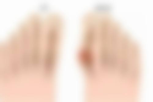 激光治疗：精细修复术后疤痕