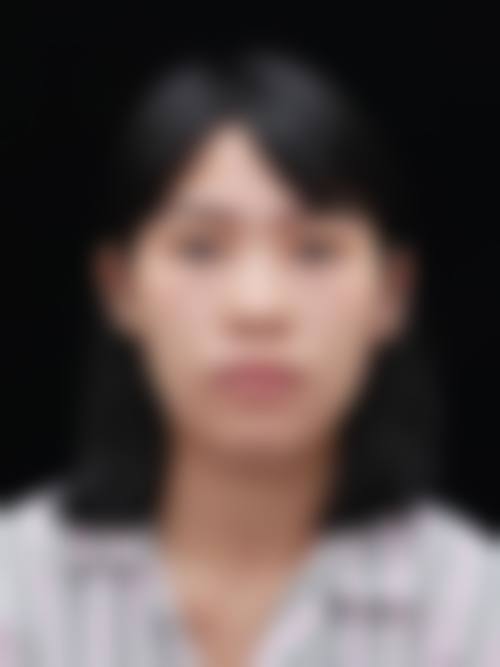 双眼皮做坏找成都林靖修复的人不少，他技术精细效果好口碑佳，预约电话：xxx