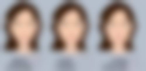 手术治疗方案:内外切除,完全告别眼袋