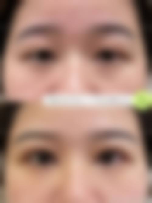 艺星的眼部技术优势