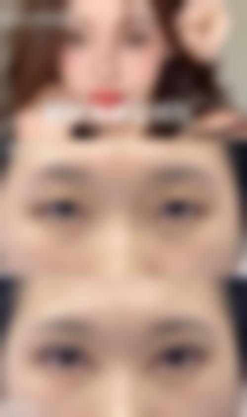 杭州艺星做双眼皮哪个医生好？洪润基、尹度龙技术精湛，手术效果自然，口碑佳！ 