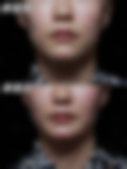 赵贵庆改脸型技术怎么样？真人案例见证神奇效果，口碑佳技术优势显著！ 