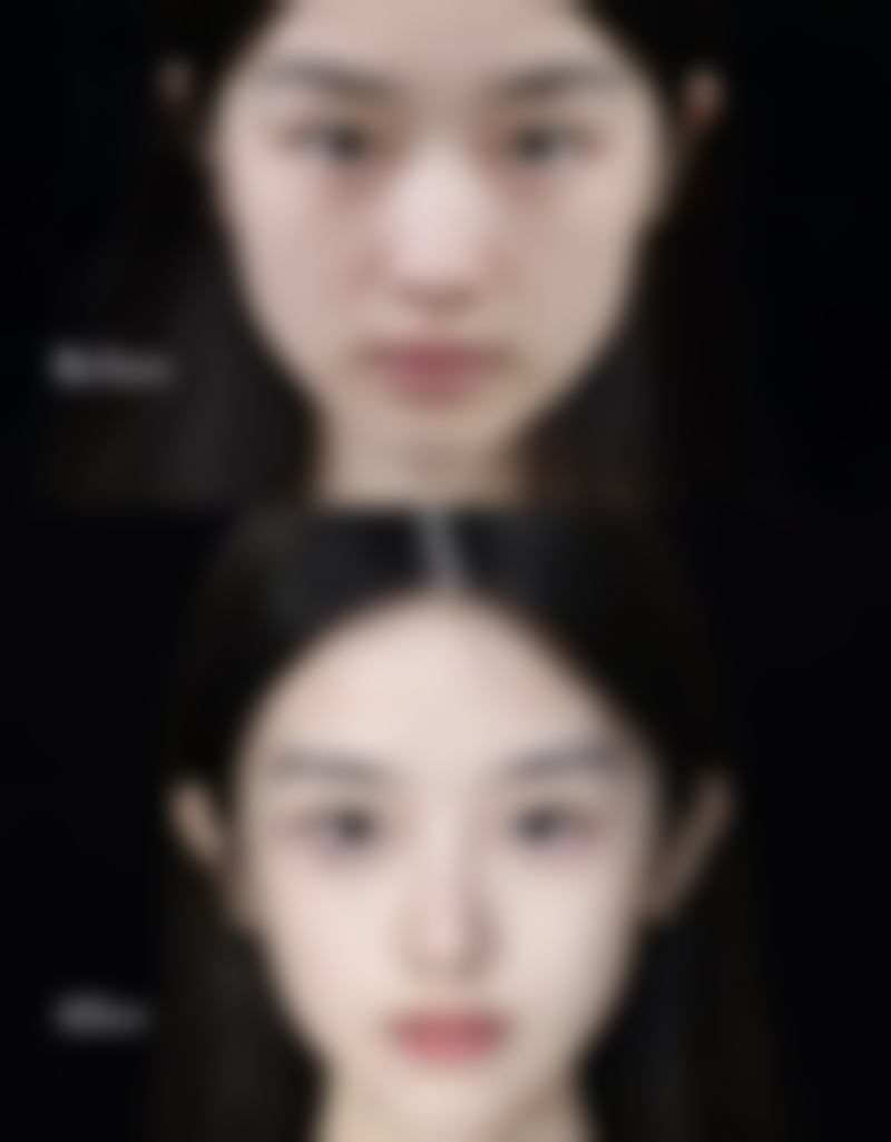 去眼袋针的选择与注意事项