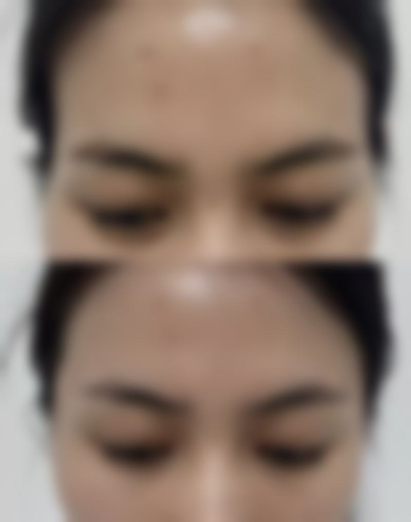 自体脂肪：源于自身，为去眼袋增添“天然感”