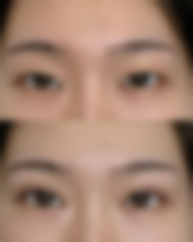 物理治疗手段:激光出击,精细消除瑕疵