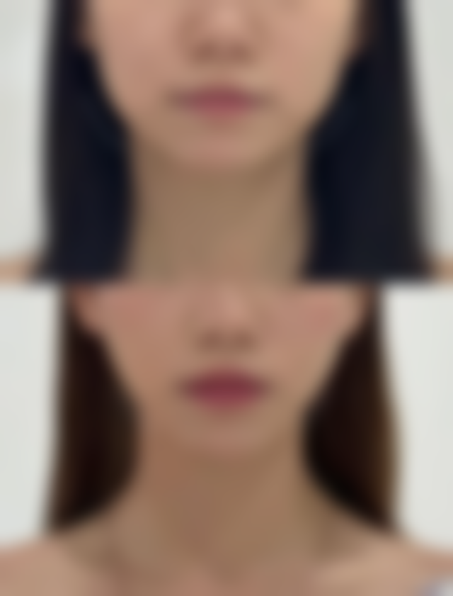 5D不开刀去眼袋成效与维持时间解析