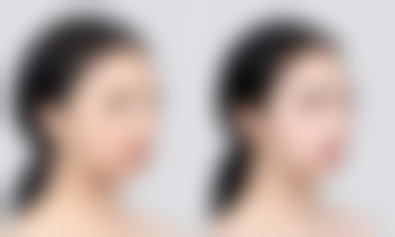 超声乳化吸脂的优点:小创伤大成效的塑形利器