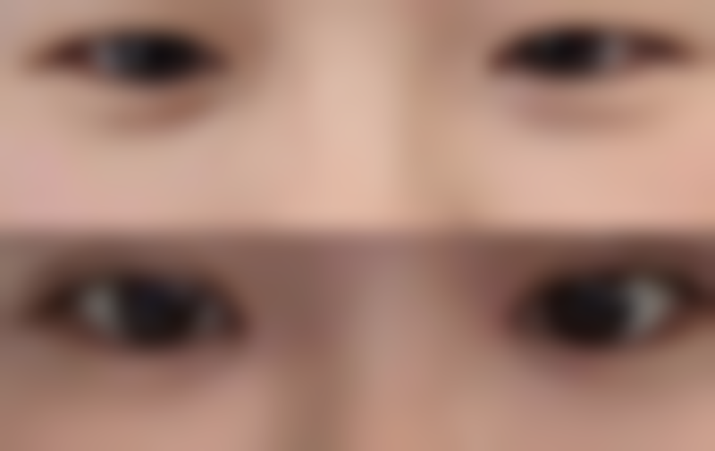 5D不开刀去眼袋术前术后注意事项大汇总