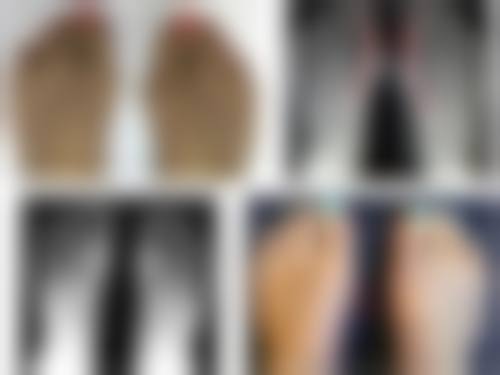 新疤痕激光可以去掉吗？当然能！新生疤痕面积小、形成时间短，多次规范治疗通常能彻底去除！ 