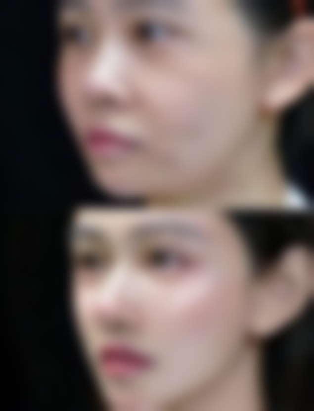 激光治疗新疤痕的过程及注意事项