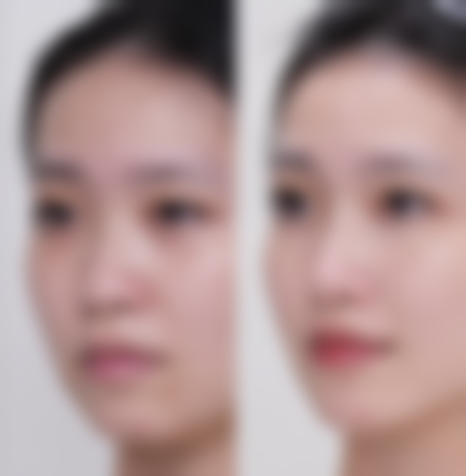 上海虹桥医院足足外翻大脚骨手术做的怎么样？微创矫正效果好，口碑佳，地址闵行虹梅路2181号 