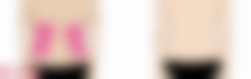 疤痕预防误区：避开陷阱让肌肤理想修复