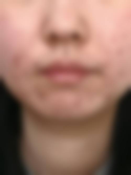 广医二院激光点痣价格表一览，单个小痣几十到一百多，技术优口碑好，电话 020 - 3415xxx ！ 